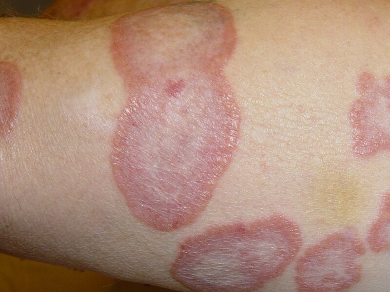 Cách trị hắc lào