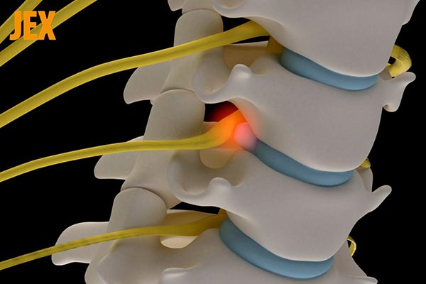 đốt sống cổ bị lồi