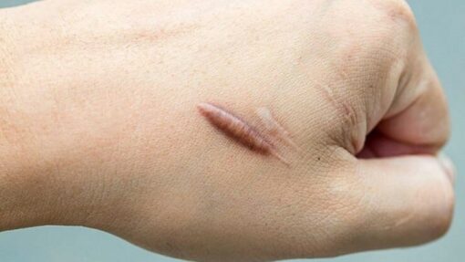 Hình xăm che sẹo