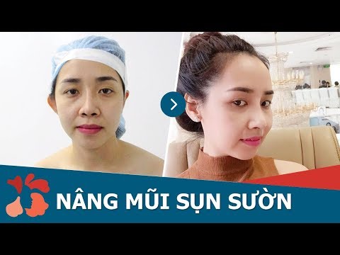 Nâng mũi sụn sườn