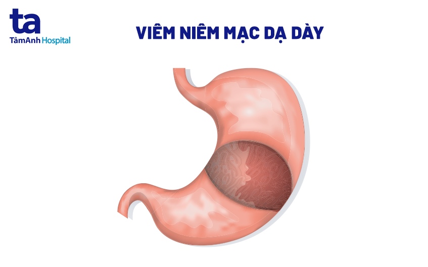 Niêm mạc dạ dày