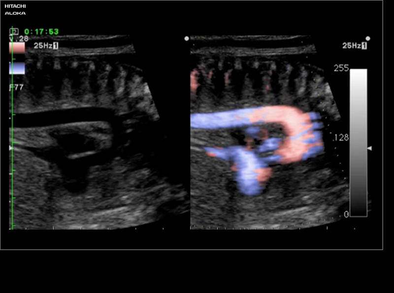 Siêu âm doppler mạch máu