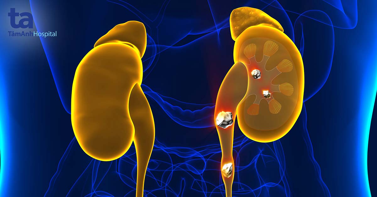 Sỏi tiết niệu là gì