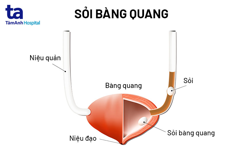 Triệu chứng sỏi bàng quang