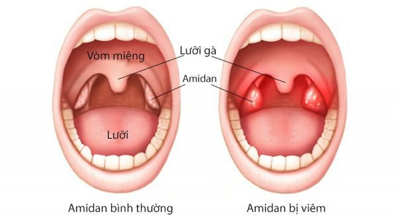 Viêm amidan uống thuốc gì