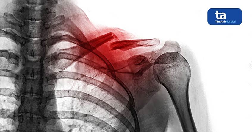 Xương đòn ở đâu